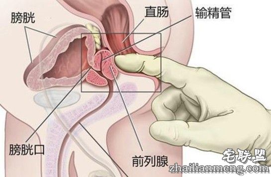 前列腺癌化疗法 前列腺癌挺“善良”治疗手段多